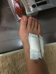 右足甲の腱鞘炎